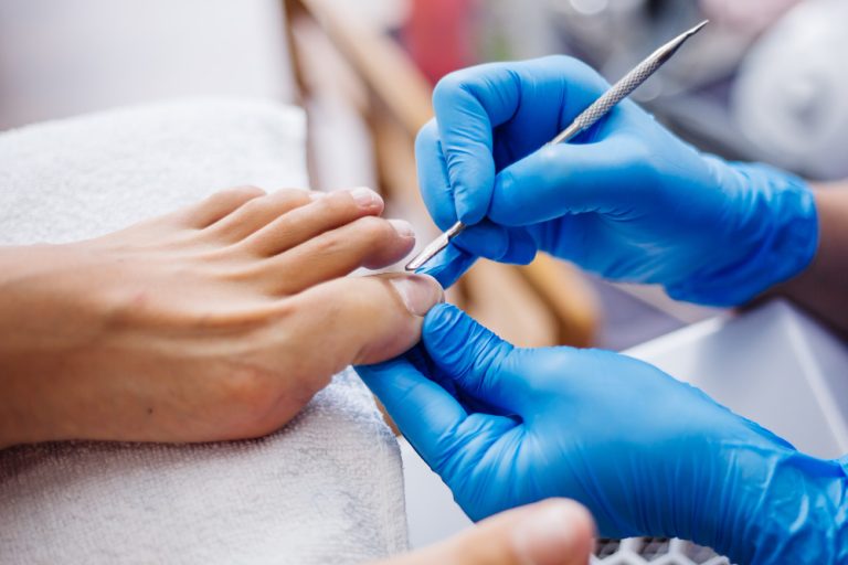 Atención podológica temprana para tratar de forma segura las uñas encarnadas